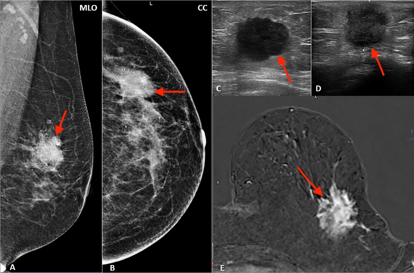 Basics of Mammography