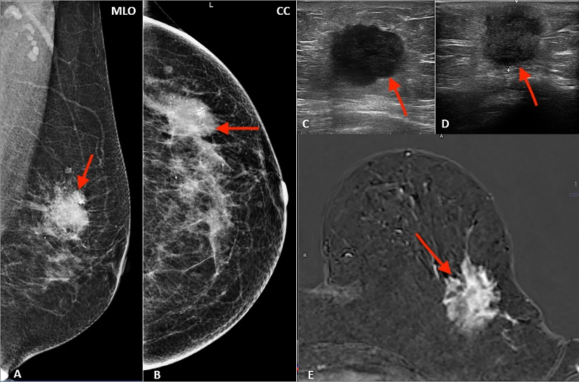 Basics of Mammography